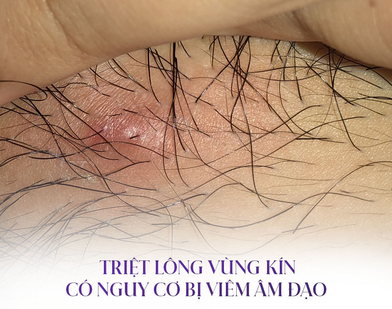 triệt lông bikini có ảnh hưởng gì không triệt lông bikini có ảnh hưởng gì không
