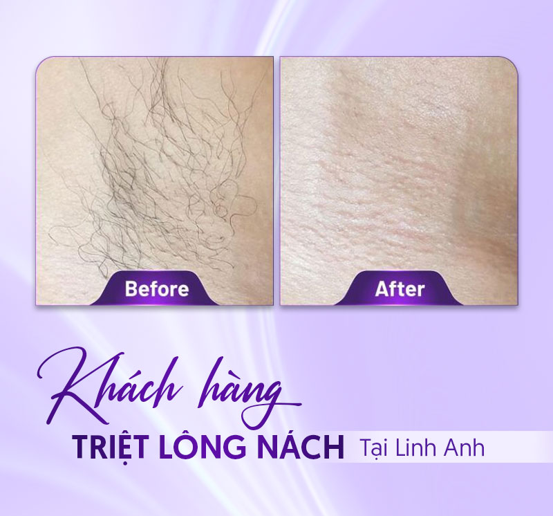 triệt lông nách bao nhiêu tiền triệt lông nách bao nhiêu tiền