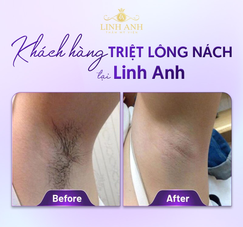 Triệt lông bằng công nghệ Laser