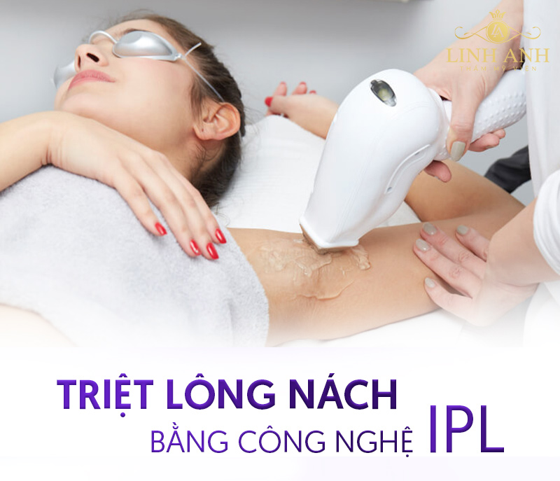 Ánh sáng IPL là công nghệ triệt lông cũ, cần nhiều buổi để duy trì hiệu quả.
