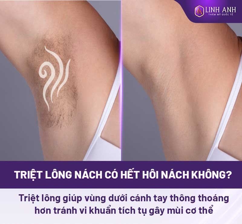 triệt lông nách có hết mùi hôi không - Thẩm mỹ Quốc tế Linh Anh triệt lông nách có giảm hôi nách