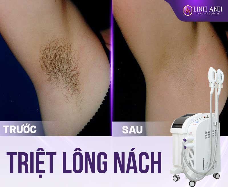 triệt lông nách có hết mùi hôi không - Thẩm mỹ Quốc tế Linh Anh triệt lông nách có làm giảm được mùi hôi