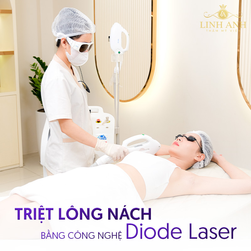 Triệt lông nách Laser Diode giá bao nhiêu