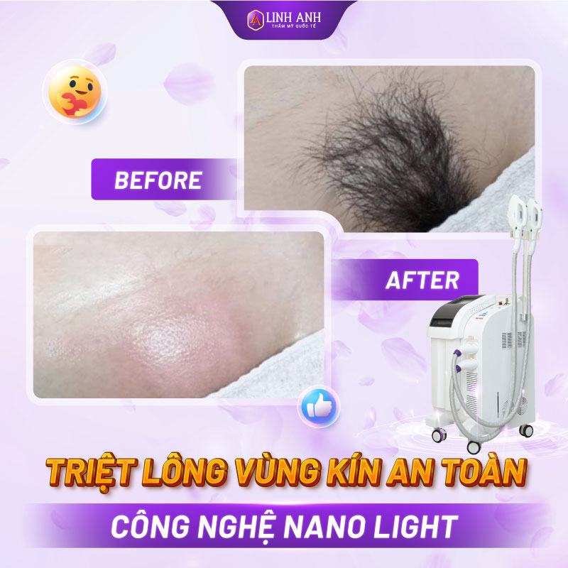 triệt lông vùng kín có ảnh hưởng gì không triệt lông vùng kín có ảnh hưởng đến sinh nở