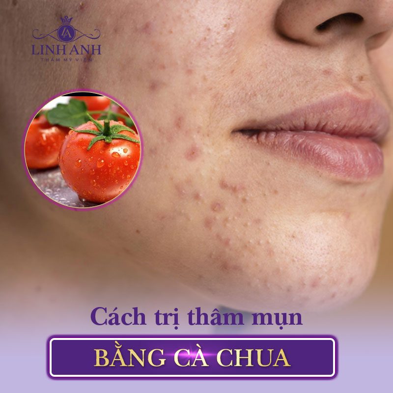 tự trị thâm mụn tại nhà