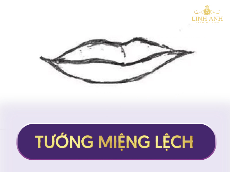 tướng miệng lệch