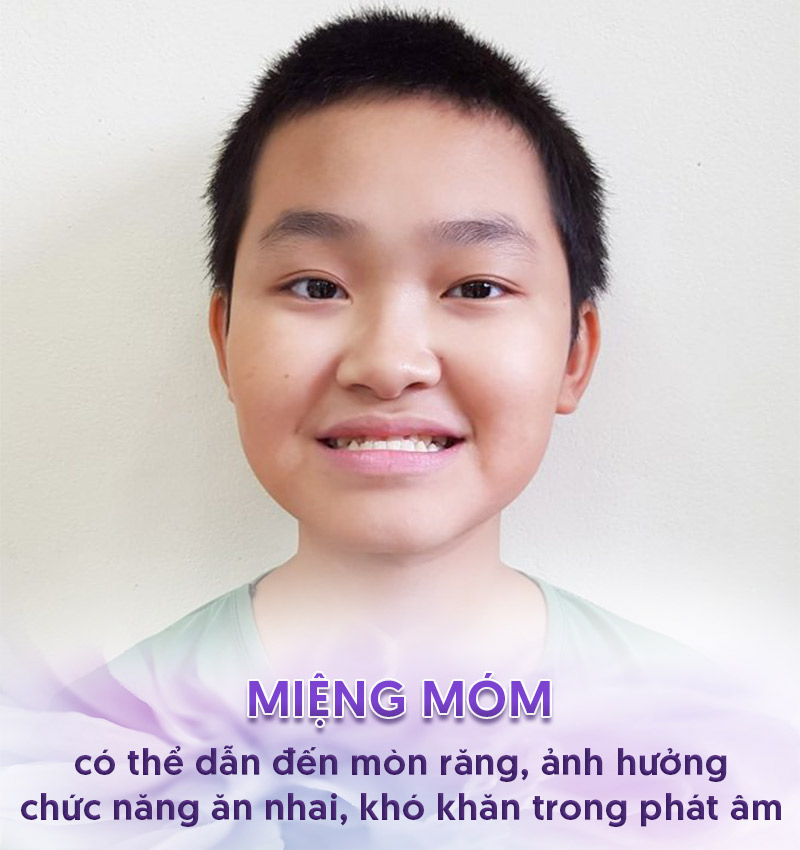 Một số tác hại của miệng móm.