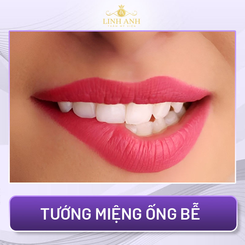 tướng môi lệch