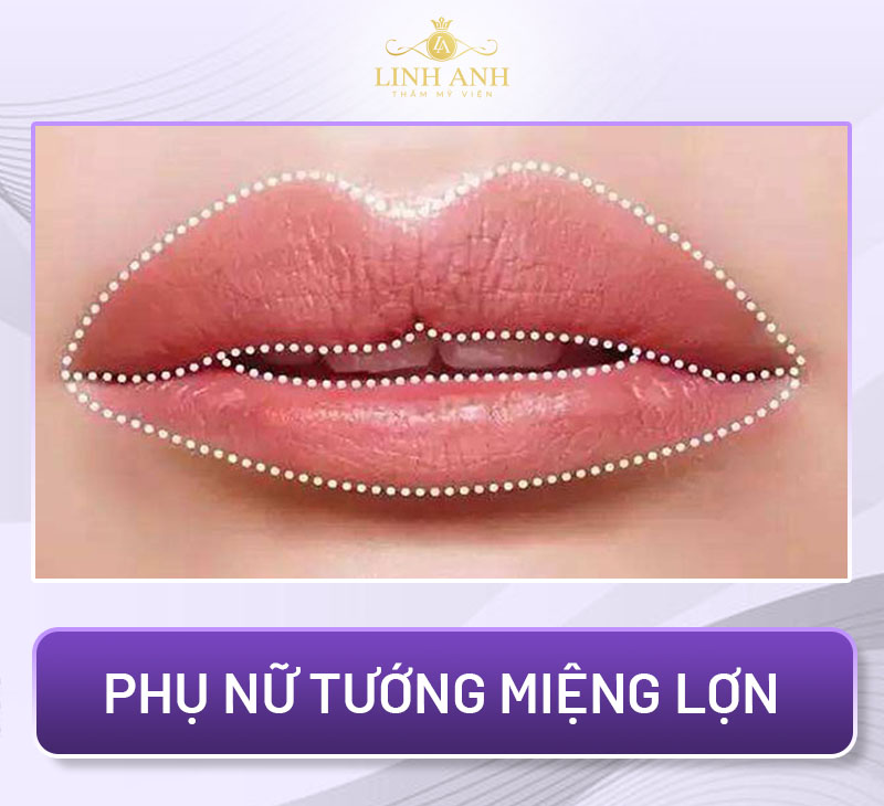 tướng môi trên cong lên