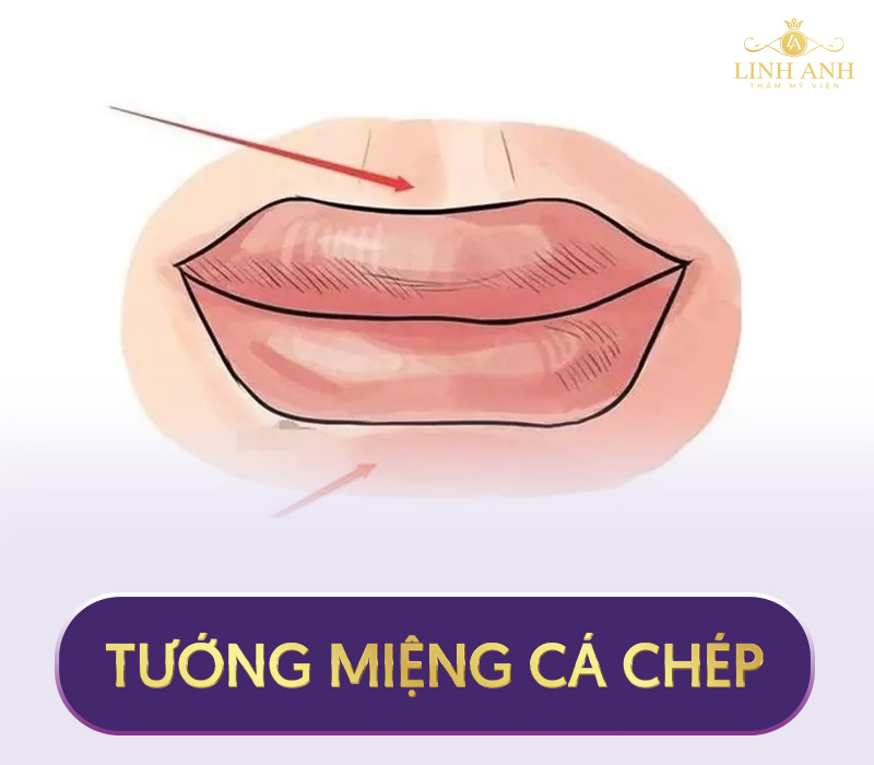 tướng môi trên nhô ra