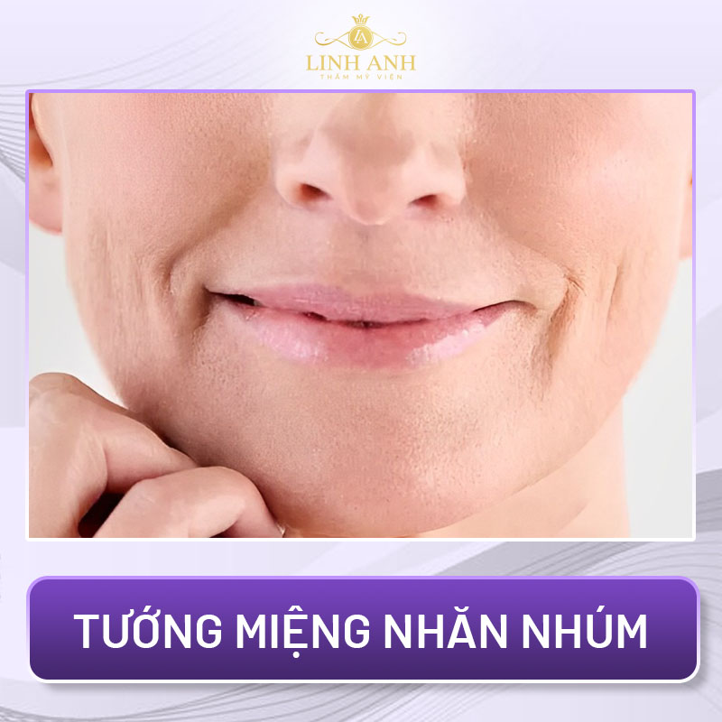 tướng môi xấu