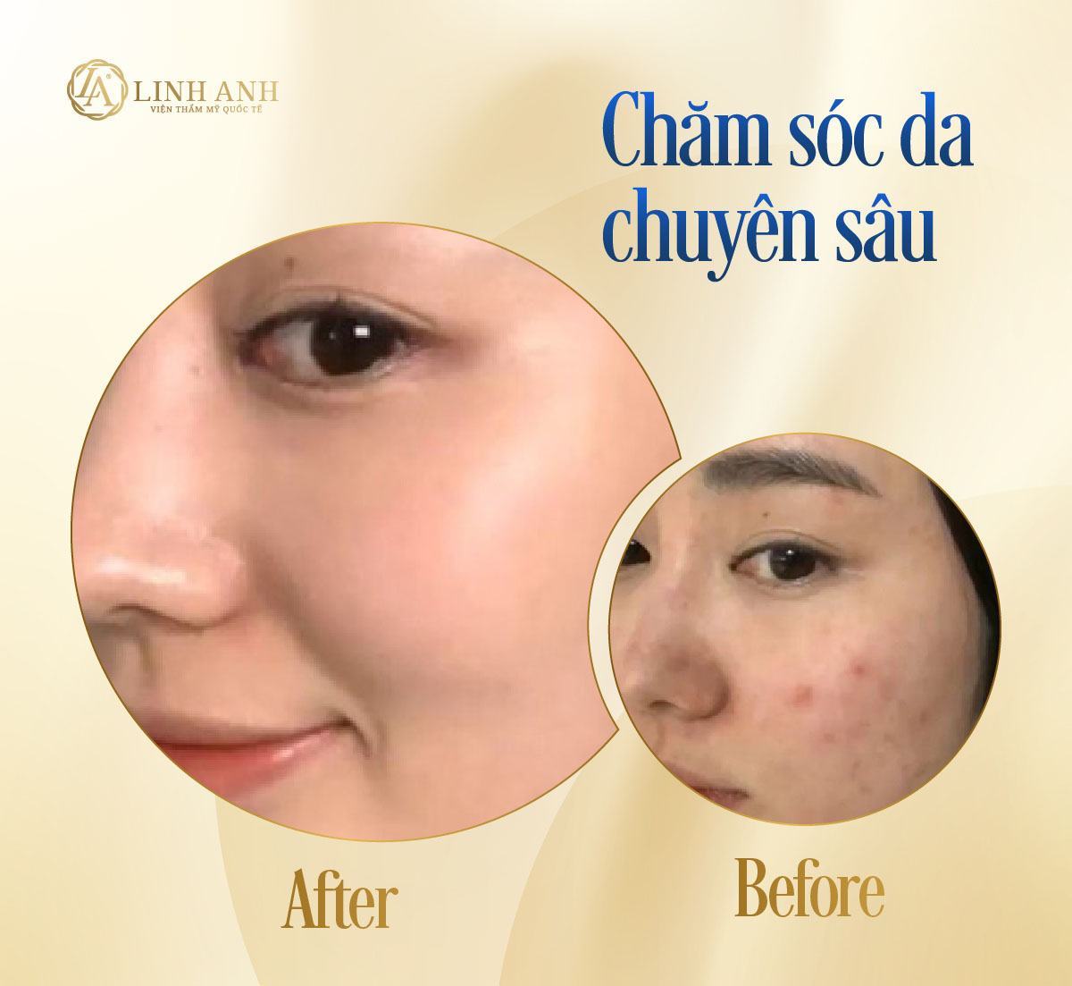 trị mụn đầu đen với vaseline hiệu quả vasaline trị mụn đầu đen - Viện thẩm mỹ quốc tế Linh Anh