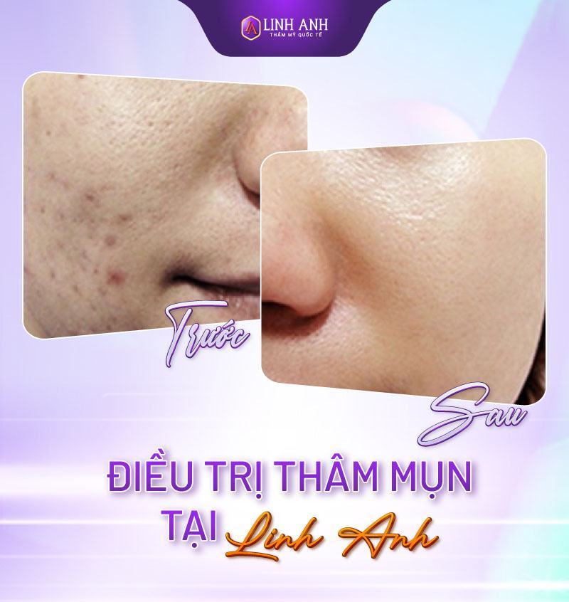 thâm mụn bao lâu thì hết vết thâm bao lâu thì hết
