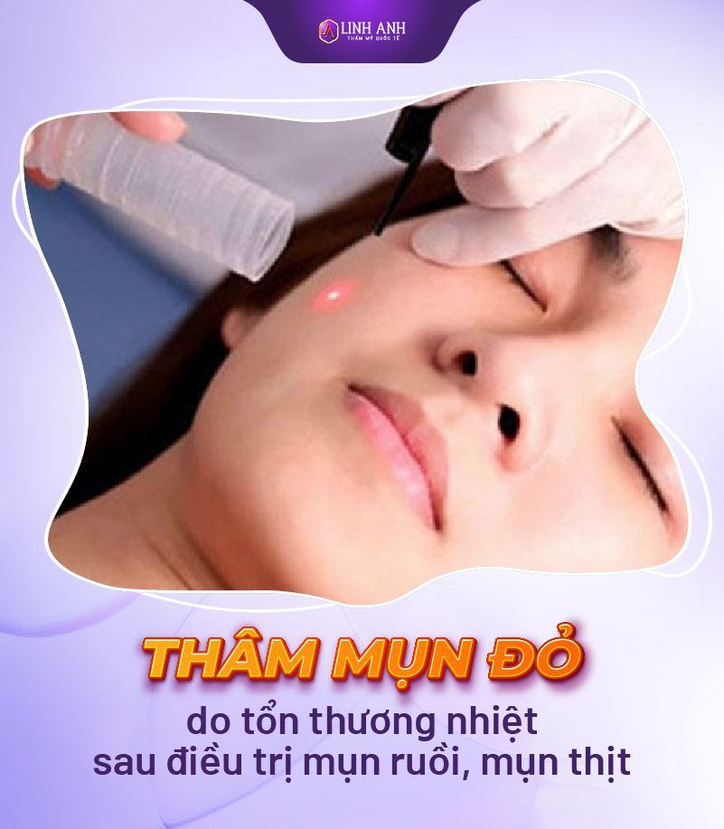 trị thâm mụn đỏ vết thâm đỏ sau mụn