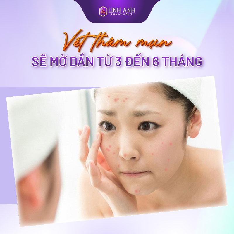 thâm mụn bao lâu thì hết vết thâm mụn bao lâu thì hết