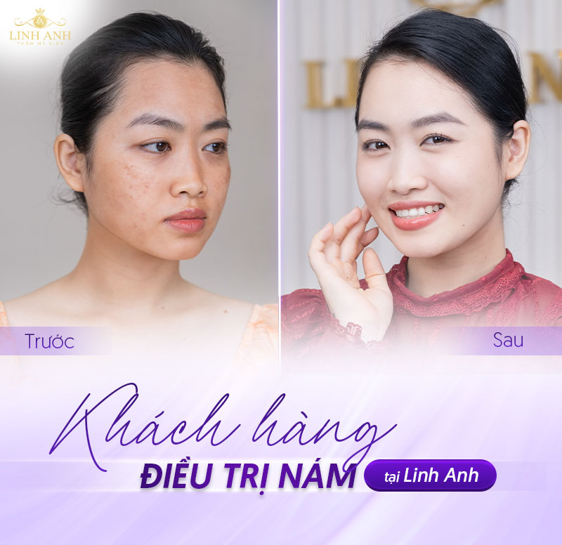 bảng giá điều trị nám bảng giá điều trị nám