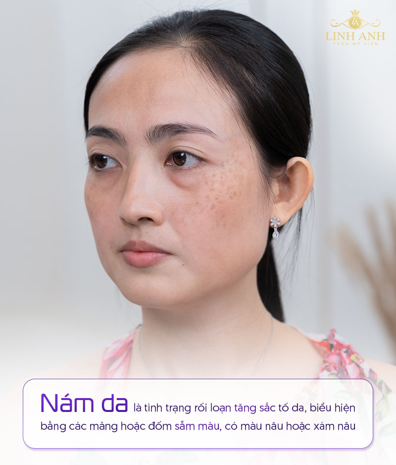 Bị nám là gì