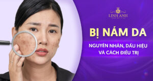 Bị nám