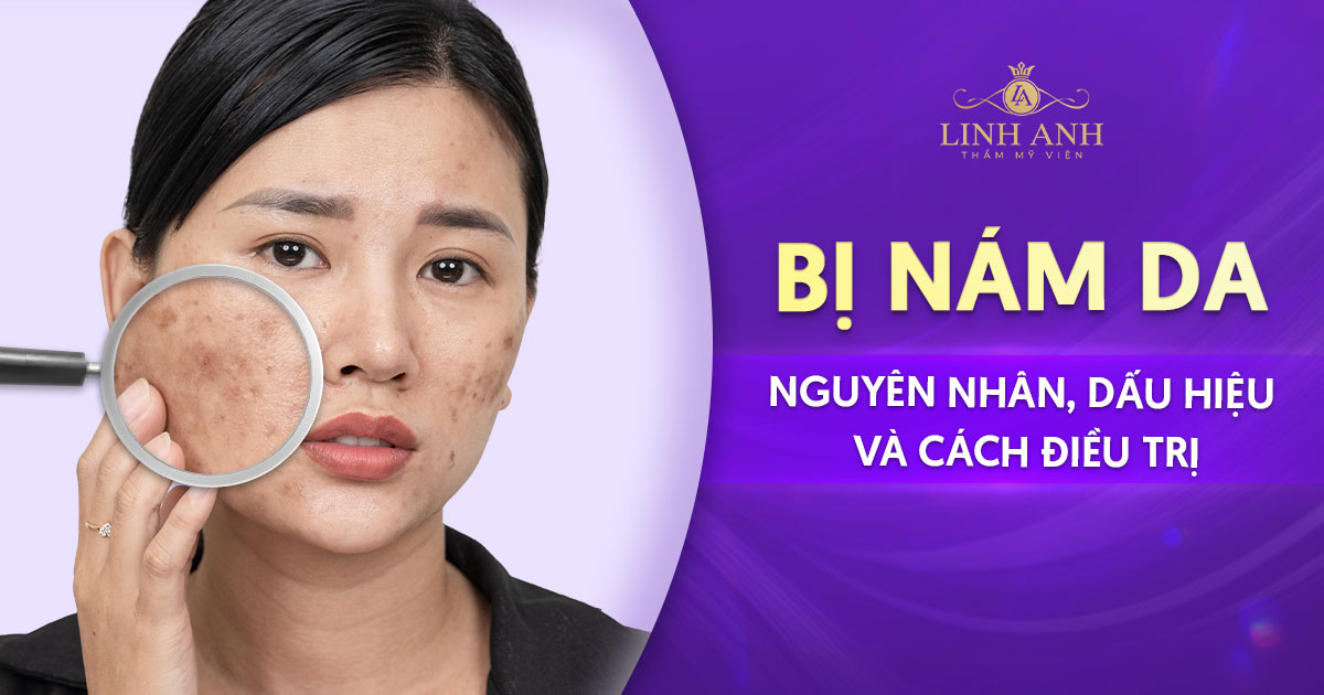 Nám da là gì? Nguyên nhân, dấu hiệu bị nám và cách điều trị