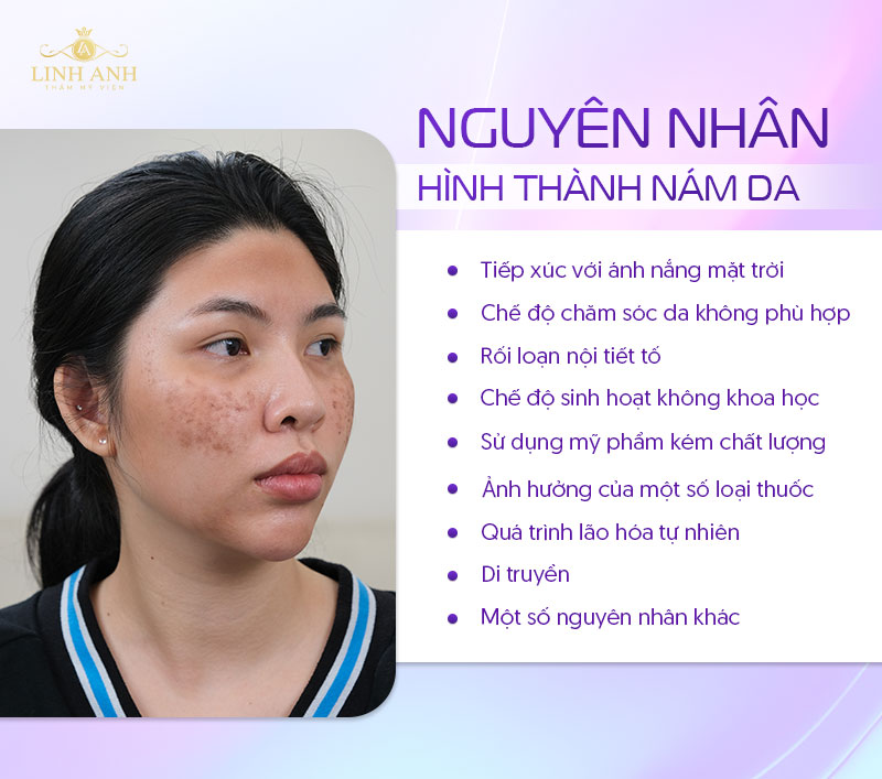 Nguyên nhân bị nám da mặt