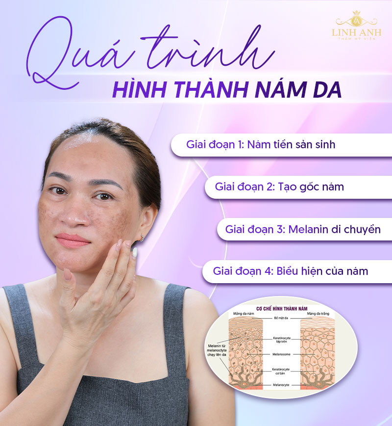 Quá trình hình thành vết nám trên mặt