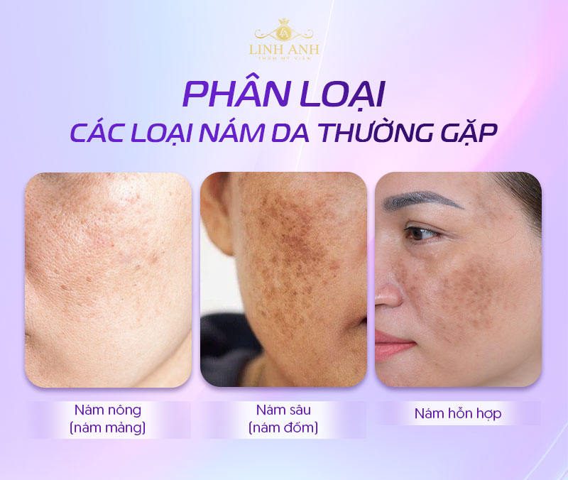 Các loại nám da