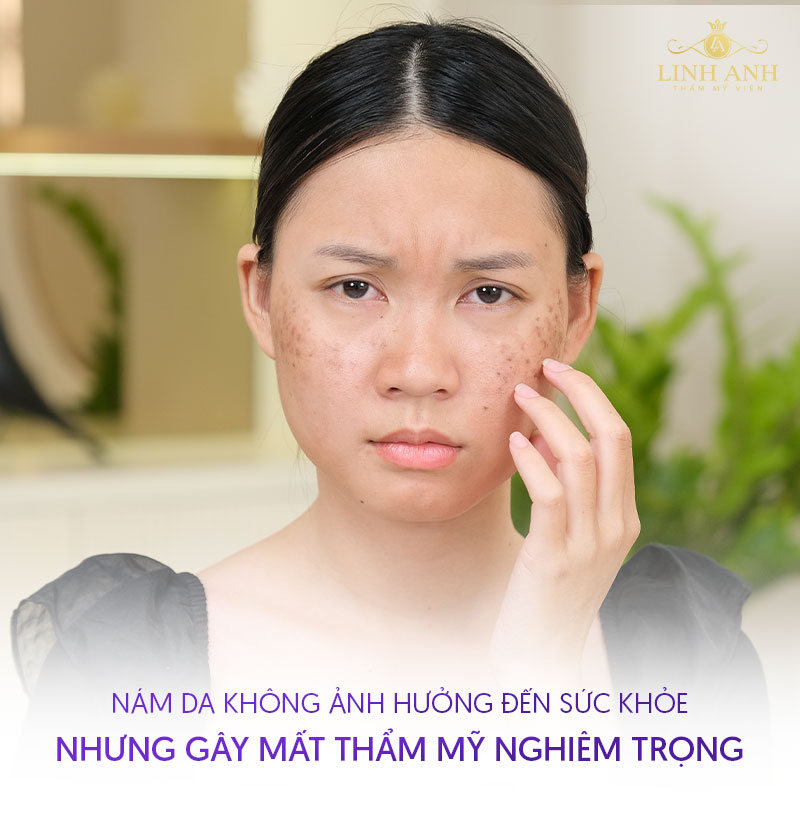 Bị nám da có sao không