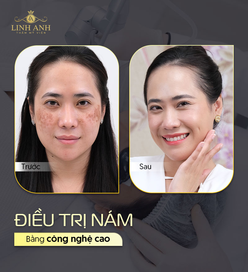 Trị nám bằng công nghệ cao