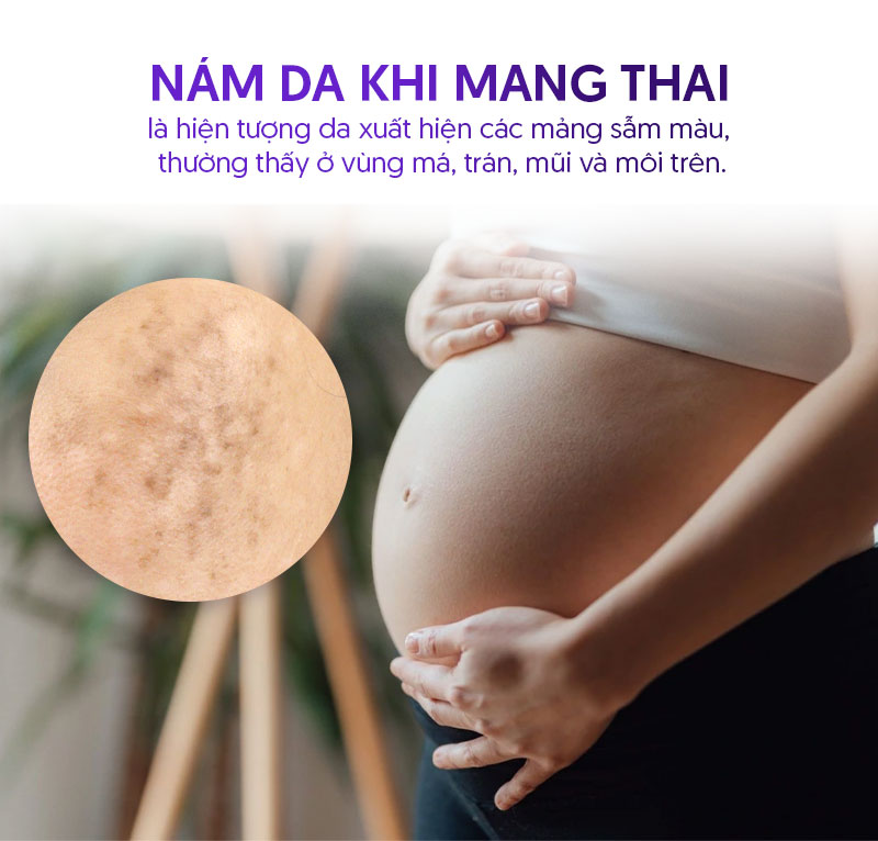 nám da khi mang thai