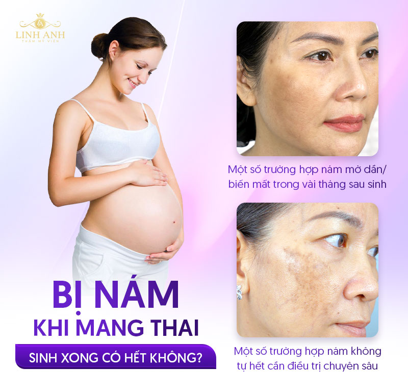 bị nám, tàn nhang khi mang thai