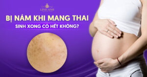 bị nám khi mang thai sinh xong có hết không