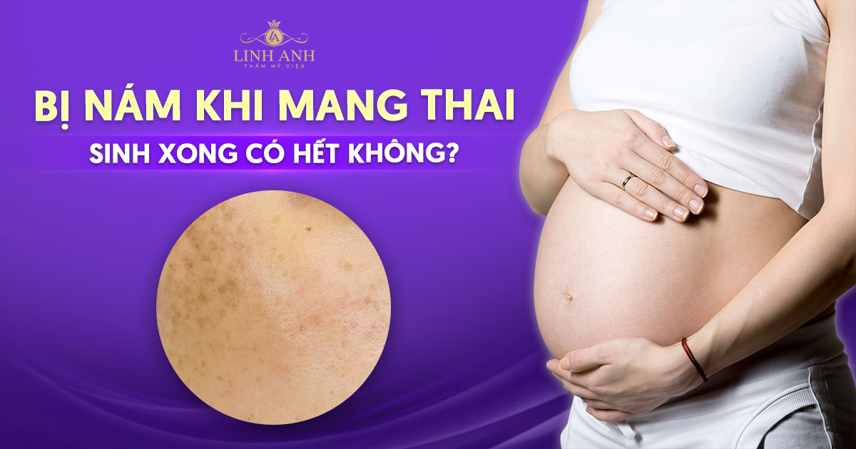 Chuyên gia giải đáp: Bị nám khi mang thai sinh xong có hết không?