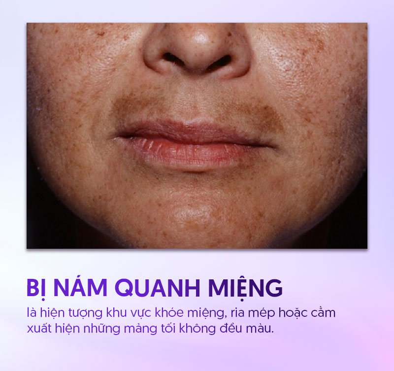 Bị nám quanh vùng miệng