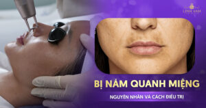 Bị nám quanh miệng và môi