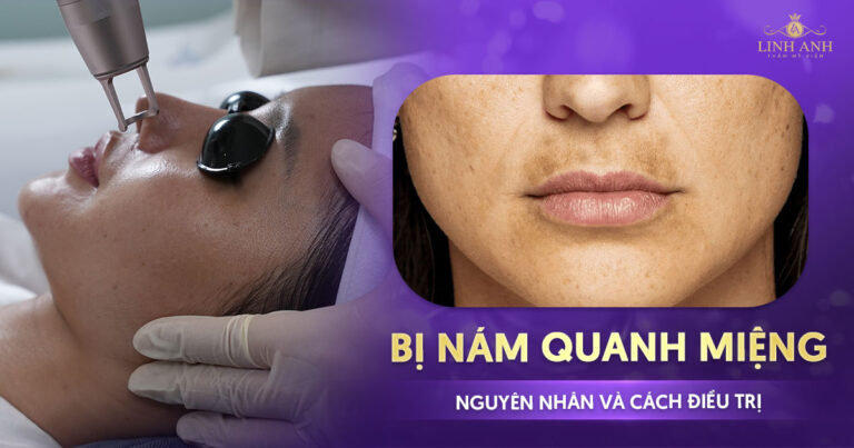 Bị nám quanh miệng: Nguyên nhân và cách điều trị hiệu quả