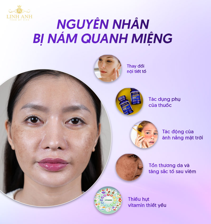 Nguyên nhân bị nám quanh miệng