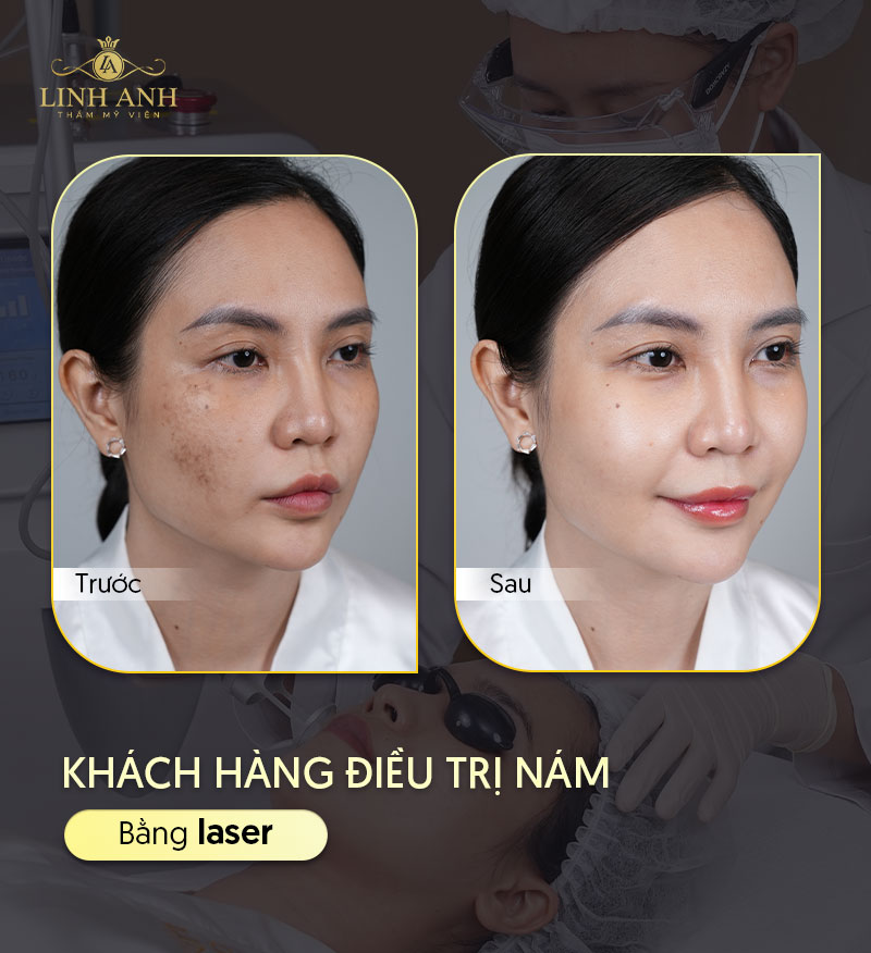 Khách hàng trị nám vùng miệng bằng laser ở Linh Anh