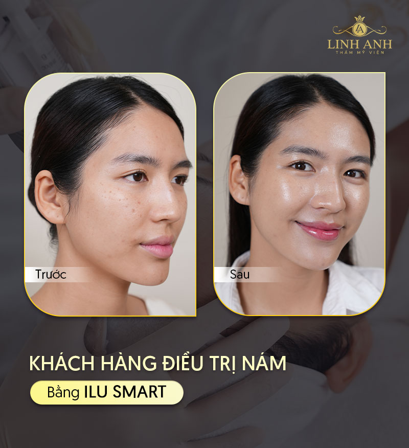 Khách hàng trị nám vùng miệng bằng Ilu SMartở Linh Anh