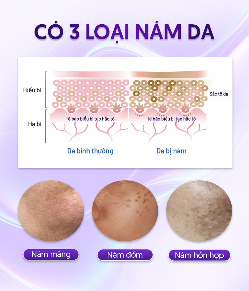 nhận biết các loại nám da