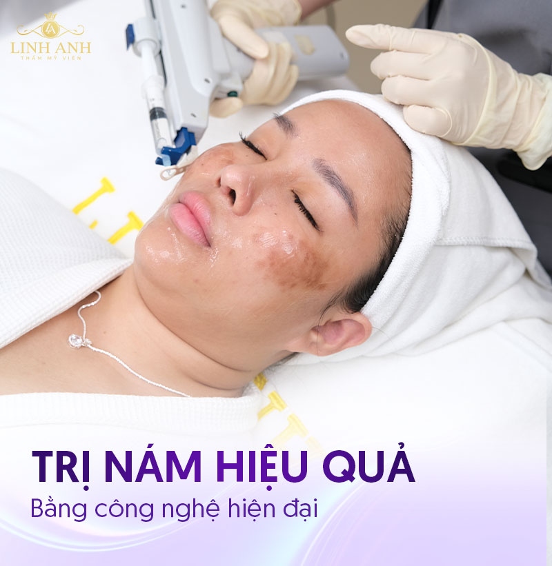 dùng công nghệ trị nám