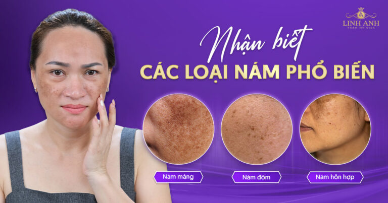Các loại nám da phổ biến: Dấu hiệu, nguyên nhân và cách điều trị