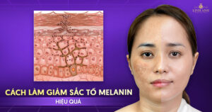 Cách làm giảm sắc tố melanin