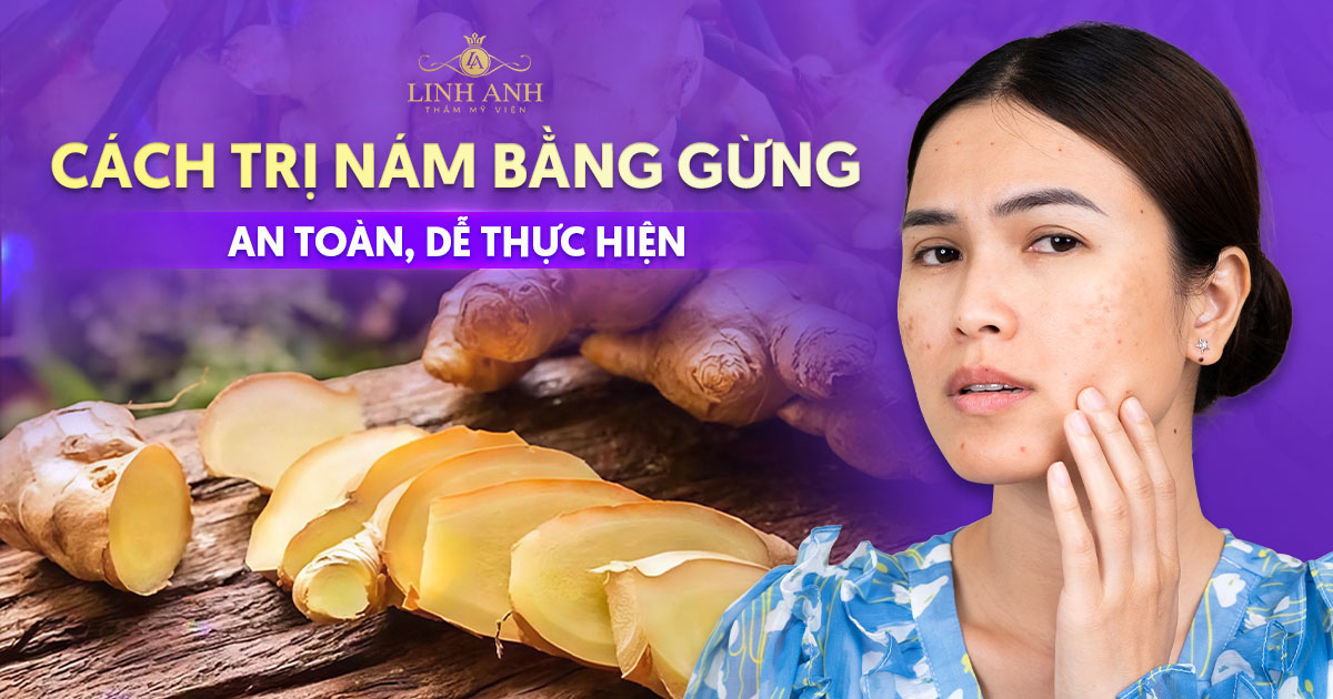 5 cách trị nám bằng gừng an toàn, ‘hạt dẻ, dễ thực hiện tại nhà