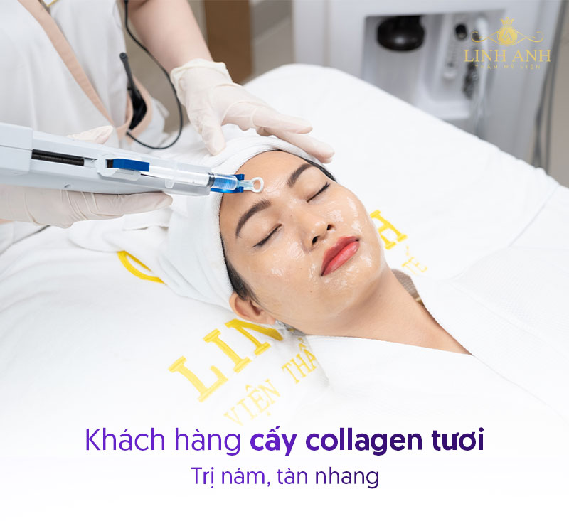 trị nám bằng cách cấy collagen tươi
