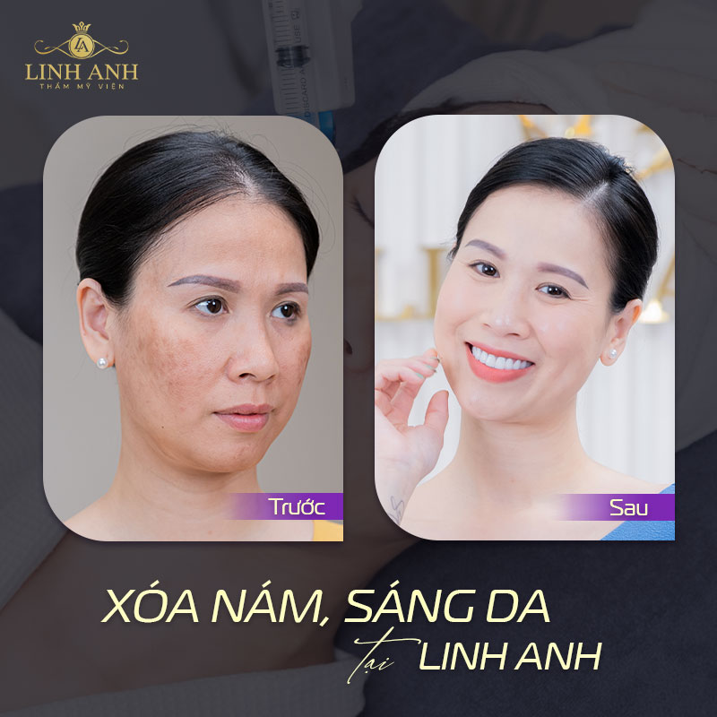 Xóa nám sáng da thành công tại Linh Anh