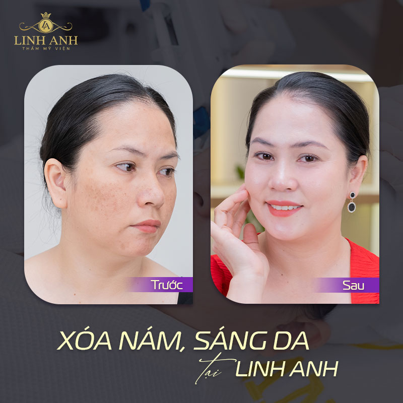 Điều trị nám hiệu quả tại Linh Anh