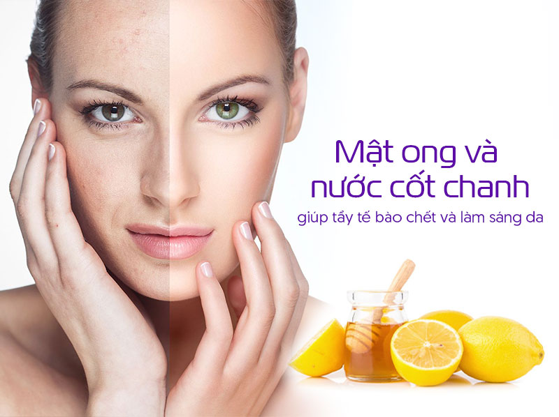 Trị nám bằng mật ong và nước cốt chanh