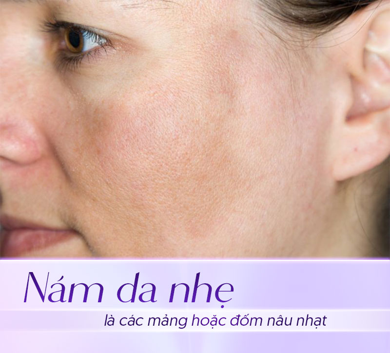 Da bị nám nhẹ là gì
