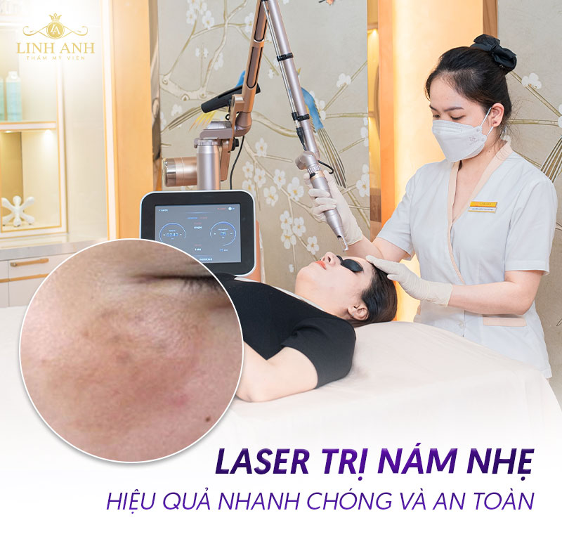 Trị nám nhẹ bằng laser