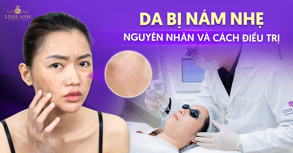 Da bị nám nhẹ: Nguyên nhân và cách điều trị hiệu quả